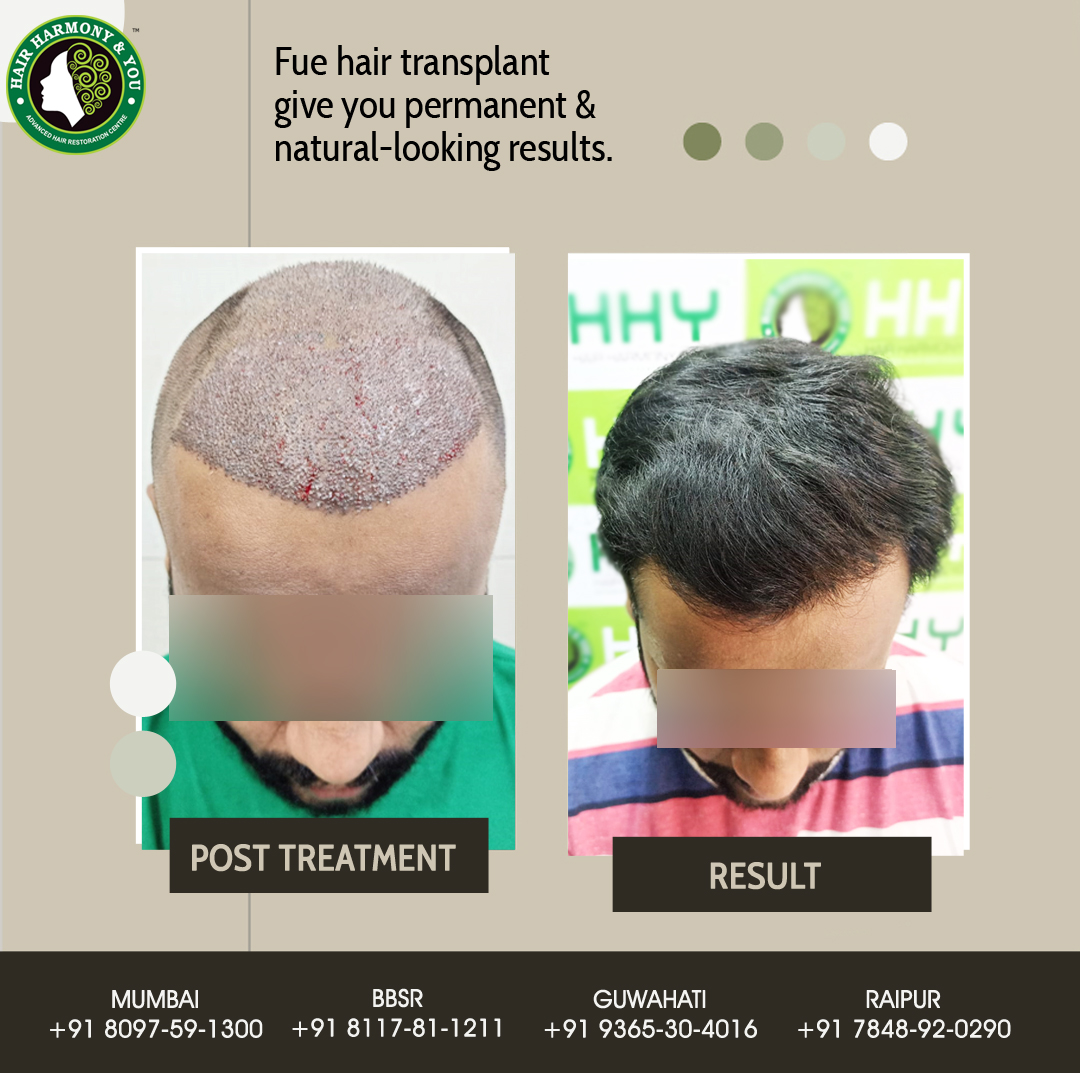 Hair Transplant Result