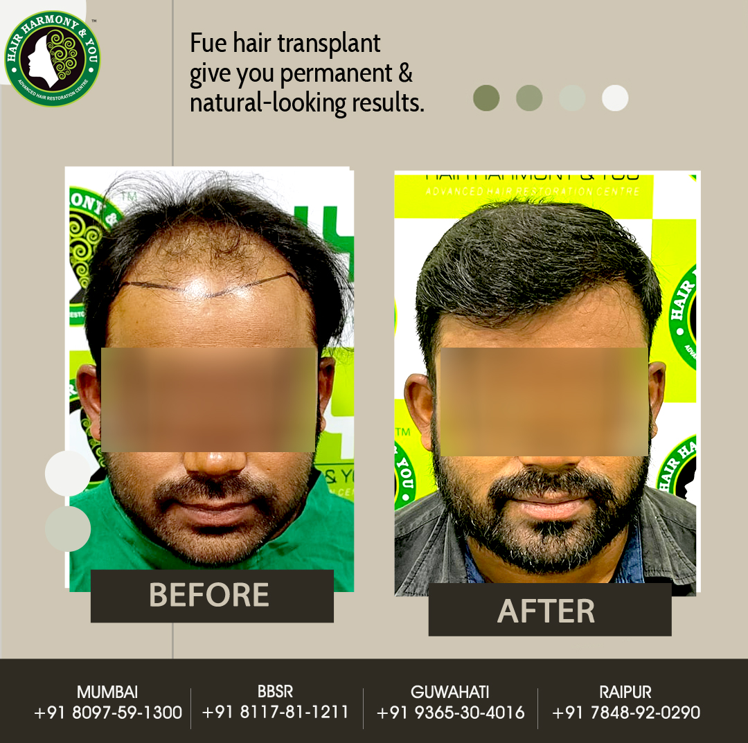 Hair Transplant Result