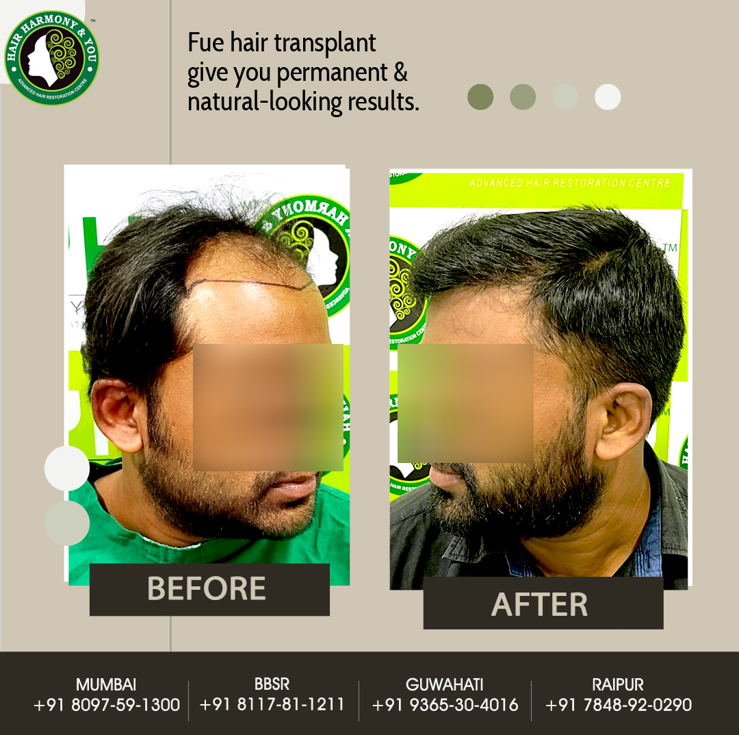 Hair Transplant Result
