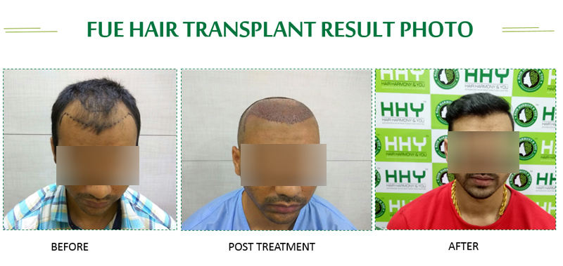 Hair Harmony and You  Hair Transplantation Clinic in Guwahati