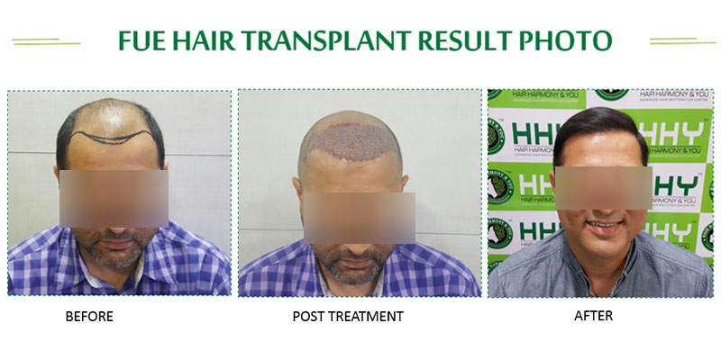 Best Hair Transplant in Guwahati  Best Hair Transplant Result  Cost in  Guwahati  YouTube