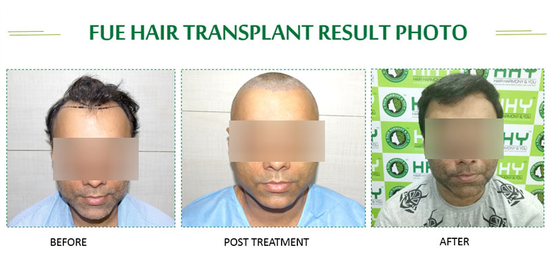 Best Hair Transplant in Guwahati  Hair Transplant Cost in Guwahati